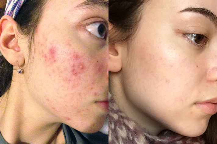 oil cleansing method acne cure