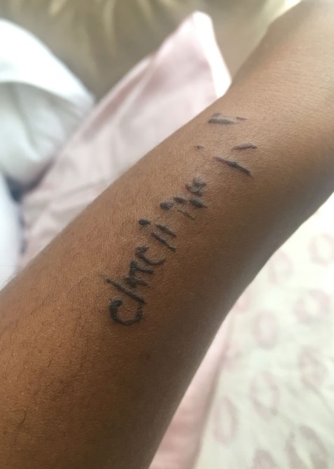 nikki-tattoo-removal-3