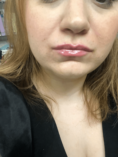 lip plump after