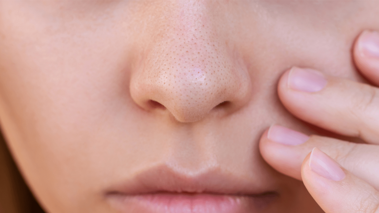 Close-up of young woman's nose with black heads or black dots. Acne problem, comedones. The girl showing enlarged pores touching the face with her hand. Blackheads on greasy skin